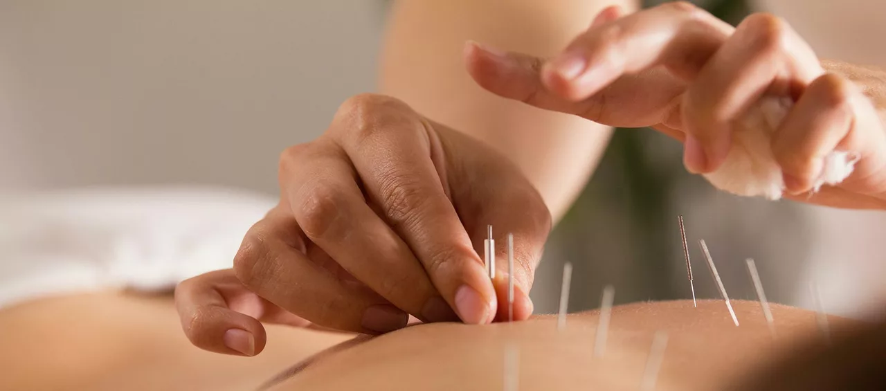 How Acupuncture Can Help with Oedema: Techniques and Benefits