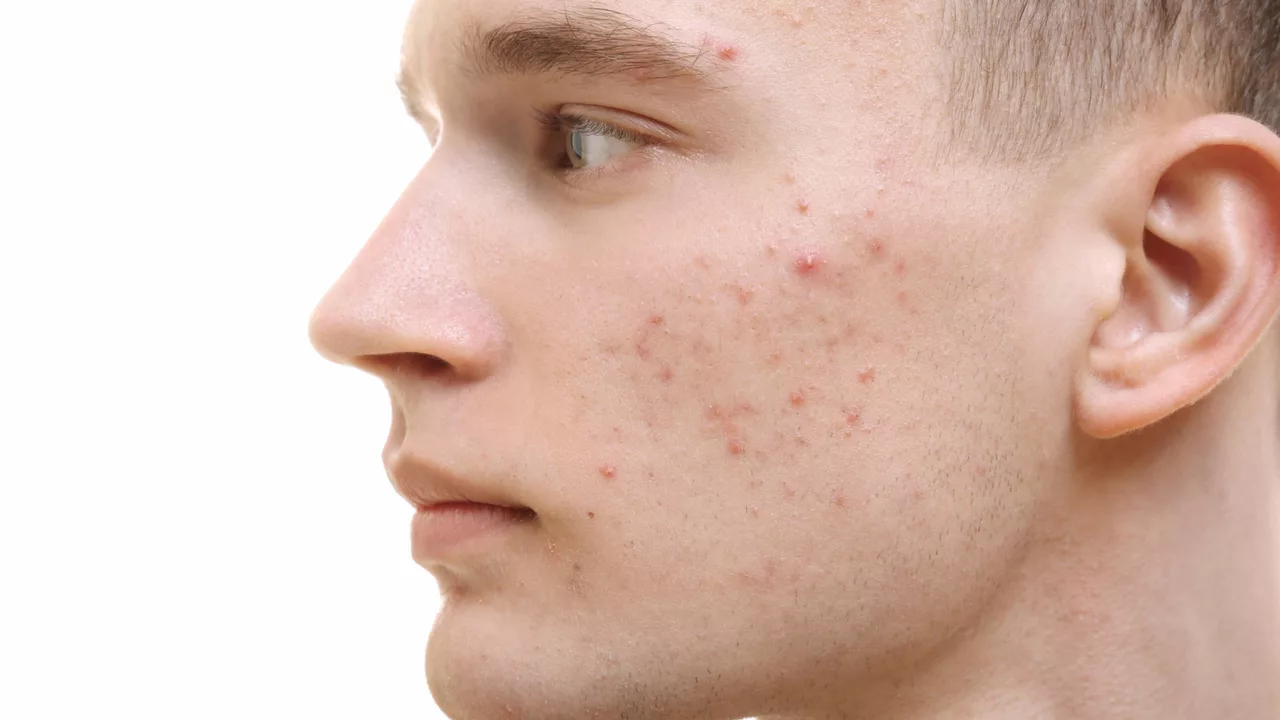 The Connection Between Nodular Acne and Gut Health